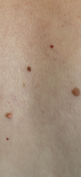 Do any of these moles/spots look concerning?