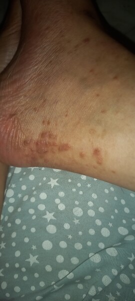 Lichen planus or dermatitis herpetiformis