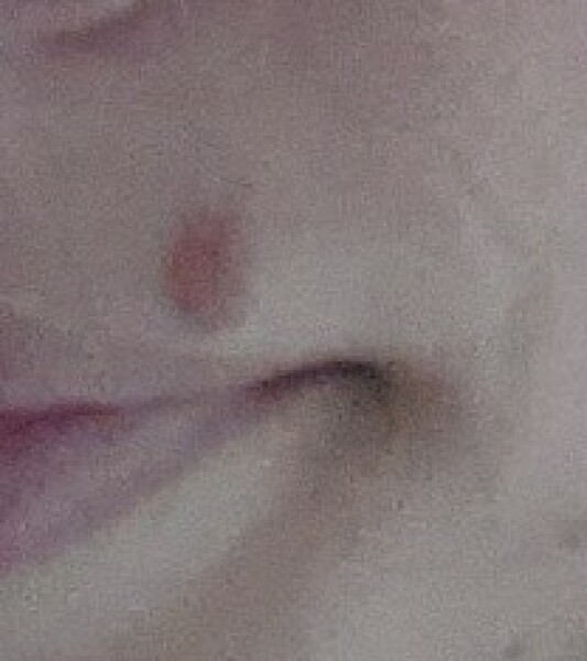 Mole removal (ultra high frequency em)