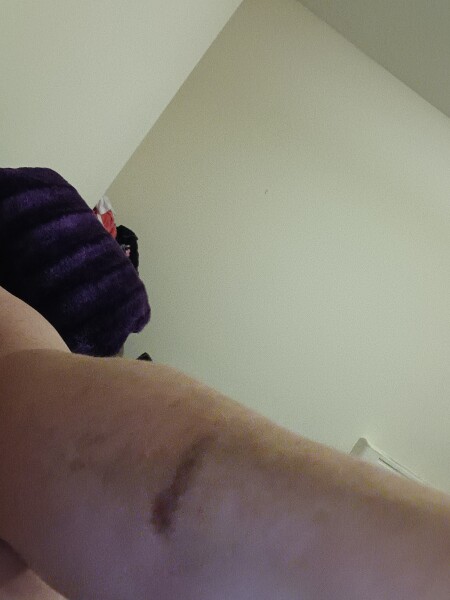 Dark patch