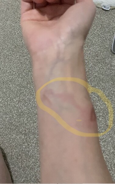Please see photo, blister popped, now raised and redness spreading