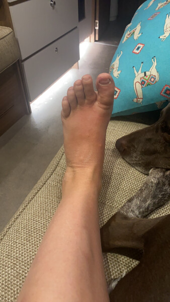 Good remedies for mosquito bites?