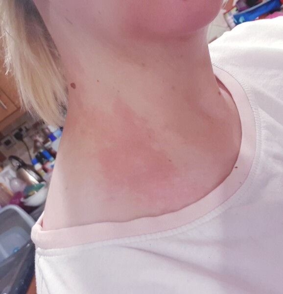 Does anyone else get this kind of rash when they're ill?