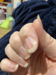 Nail problem 