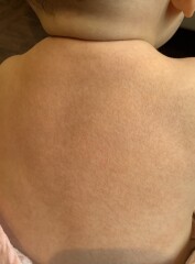 Rash (with pics)