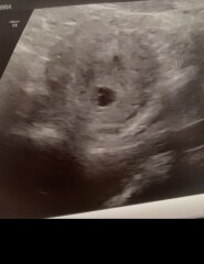 Pregnancy after miscarriage