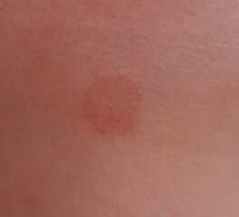 Mark on my breast (pics included)