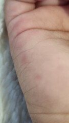 Does this look like Hand Foot & Mouth?