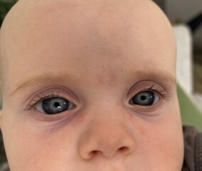 Baby spots around eyes 