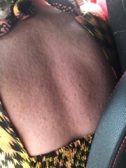Is this heat rash?