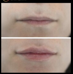 Lip fillers - help!