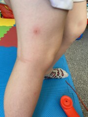 Can you identify these bites? 