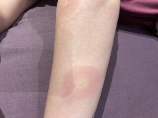 What has bitten me?!