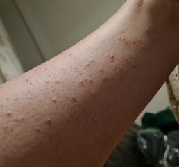 Help me identify this rash and stop the itch!