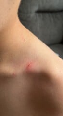 Is this chickenpox?