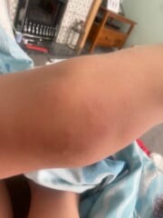 Is this measles or chicken pox or what? 