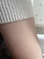 Small red freckles starting to appear 