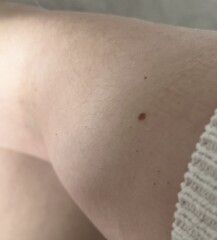 Small red freckles starting to appear 