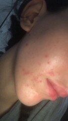 Spotty skin