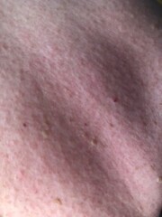 Is this heat rash?