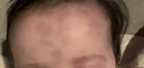 Purple blotches 