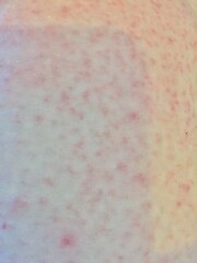 cant get rid of prickly heat rash pics included