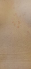 Weird blotches on skin - any ideas?