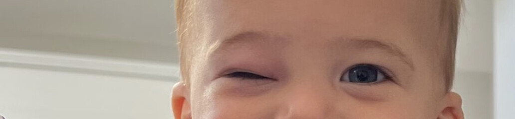 Does this look like periorbital cellulitis? 