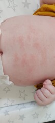 Baby Vaccine side effects