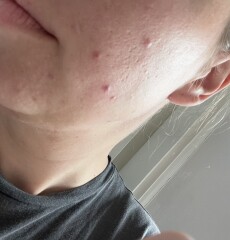 Getting married in 4 weeks and skin has gone to sh*t