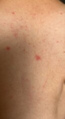 Is this chickenpox?