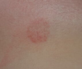 Mark on my breast (pics included)
