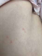 Chicken pox??