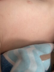 Is this measles or chicken pox or what? 