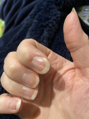 Nail problem 