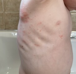 Rash 14 months old.