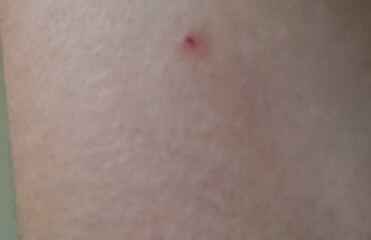 Cherry Angionoma or Nodular Melanoma?