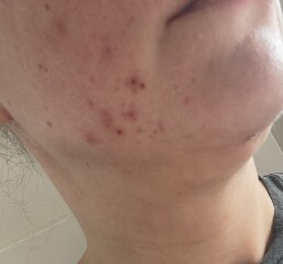 Getting married in 4 weeks and skin has gone to sh*t