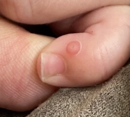 Strange spot on finger??