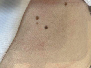 Is this mole cancer?