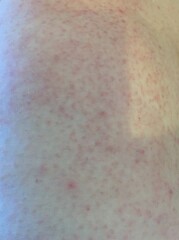 cant get rid of prickly heat rash pics included