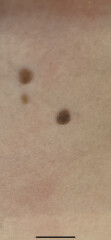 Is this mole cancer?