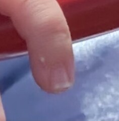 Strange spot on finger??