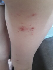 Rash on dd