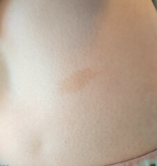 Worried about Café au lait marks?
