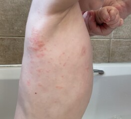 Rash 14 months old.