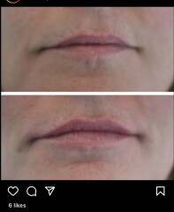 Lip fillers - help!