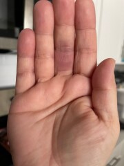 Achenbach syndrome - help, please!