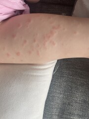 Is this eczema? (With pics)
