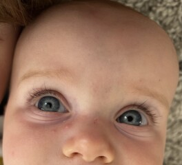 Baby spots around eyes 